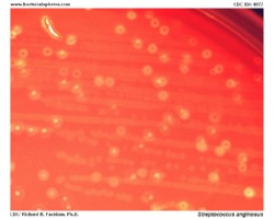 streptococcus anginosus